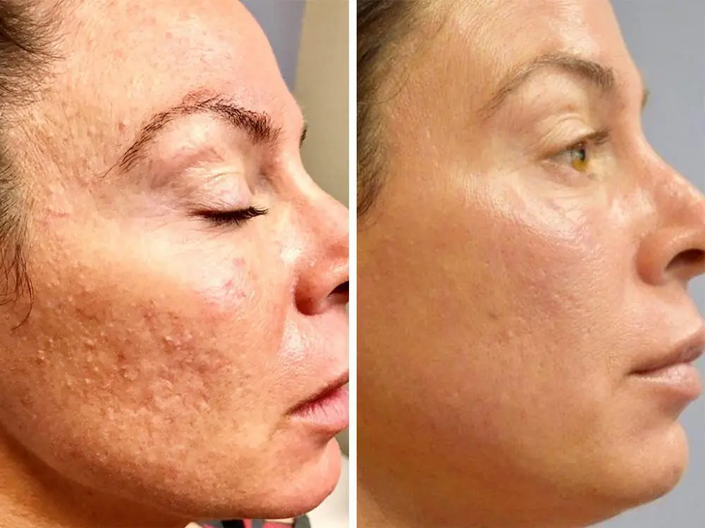 Microneedling - transformare incredibilă pentru un ten neted, luminos și uniform.